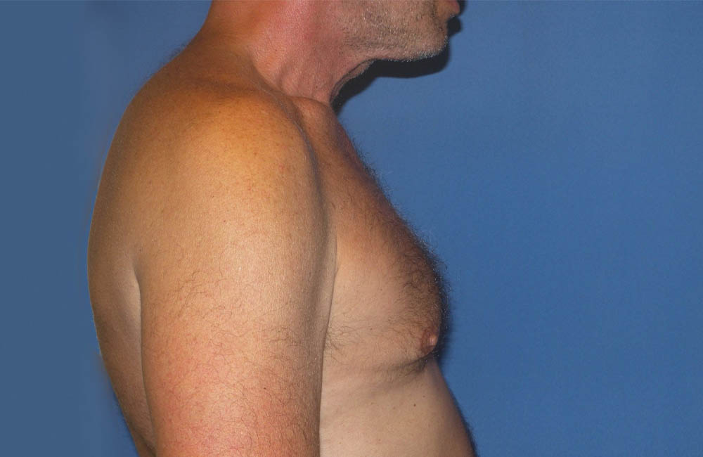 Male Breast Reduction case #4870