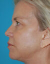 Forehead Lift case #4395