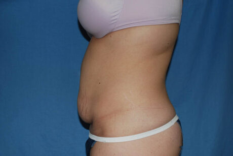 Mommy Makeover case #5616