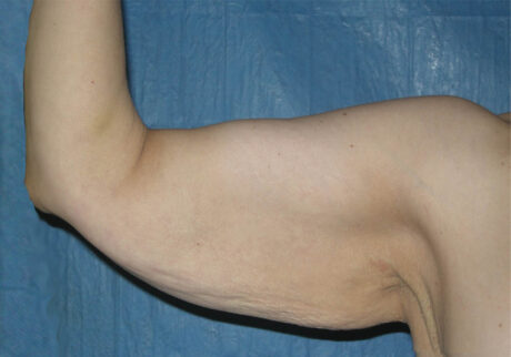 Arm Lift case #3723