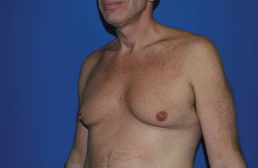 Male Breast Reduction case #4870
