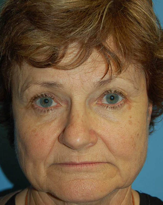 Forehead Lift case #4400