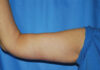 Arm Lift case #3723