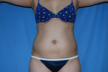 Liposuction case #4536