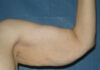 Arm Lift case #3723