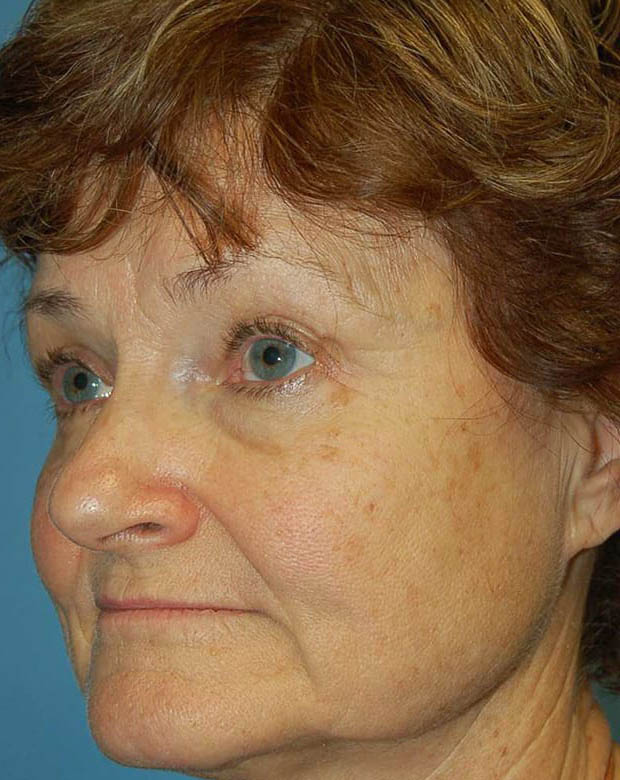 Forehead Lift case #4400