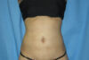 Liposuction case #4536