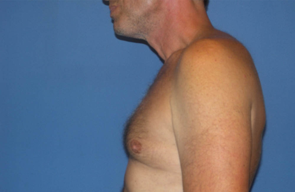 Male Breast Reduction case #4870