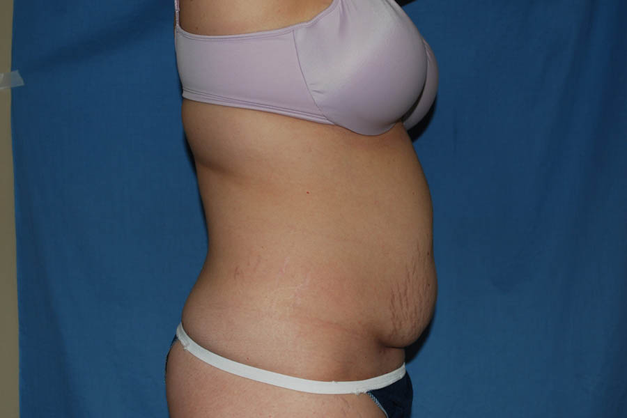 Mommy Makeover case #5616