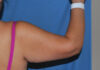 Arm Lift case #3728