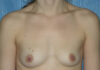 Breast Augmentation case #3926