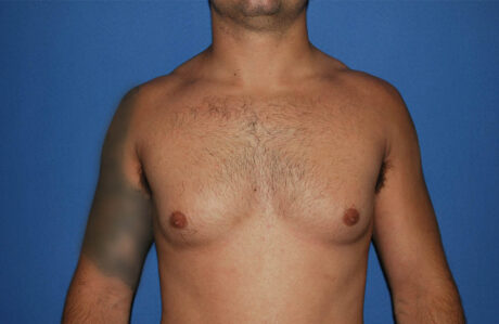 Male Breast Reduction case #4881