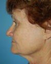 Forehead Lift case #4400