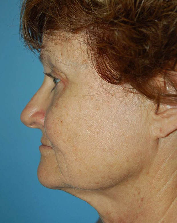 Forehead Lift case #4400