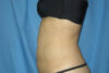 Liposuction case #4536