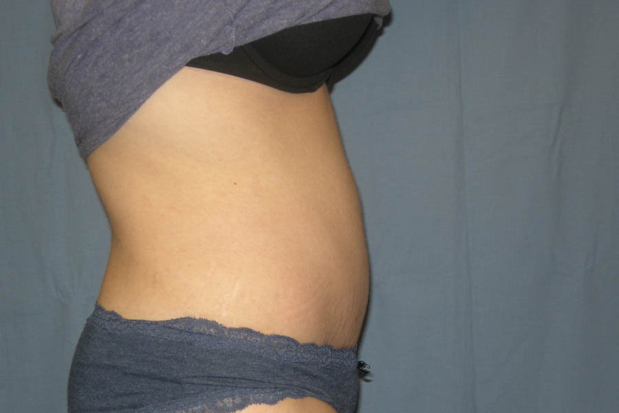 Mommy Makeover case #5616