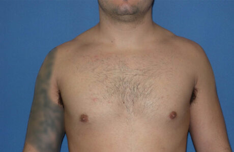 Male Breast Reduction case #4881