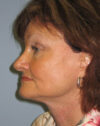 Forehead Lift case #4400