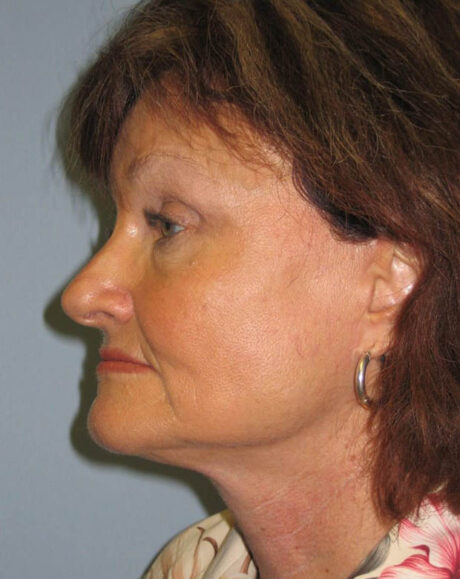 Forehead Lift case #4400