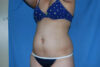 Liposuction case #4536