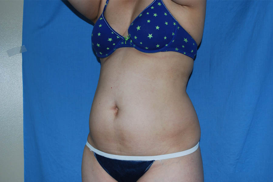 Liposuction case #4536