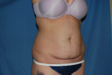 Mommy Makeover case #5616