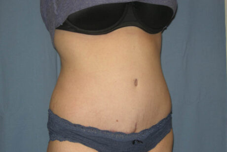 Mommy Makeover case #5616