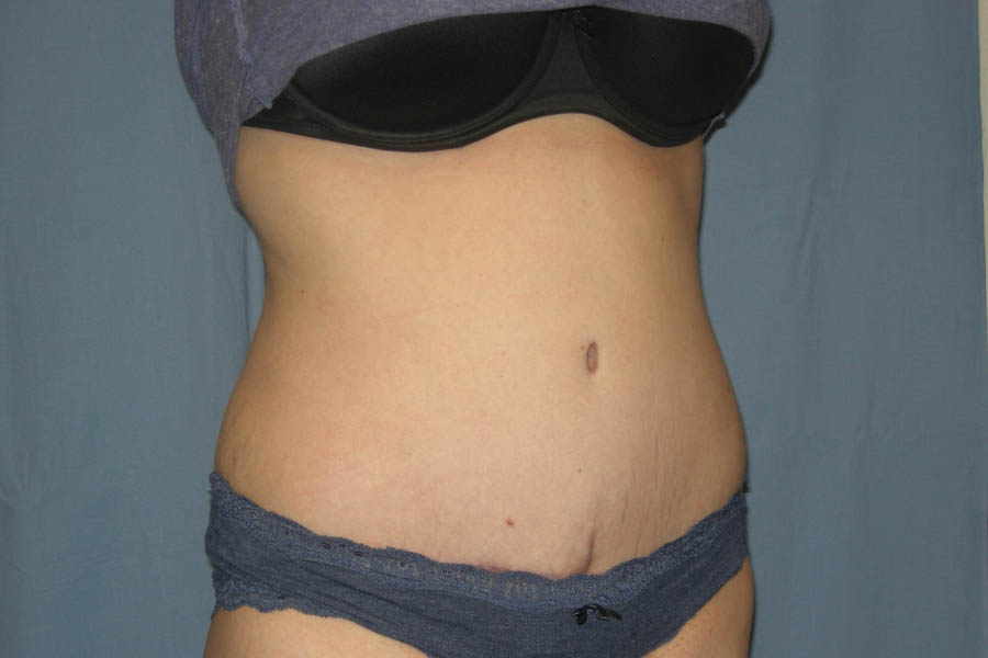 Mommy Makeover case #5616