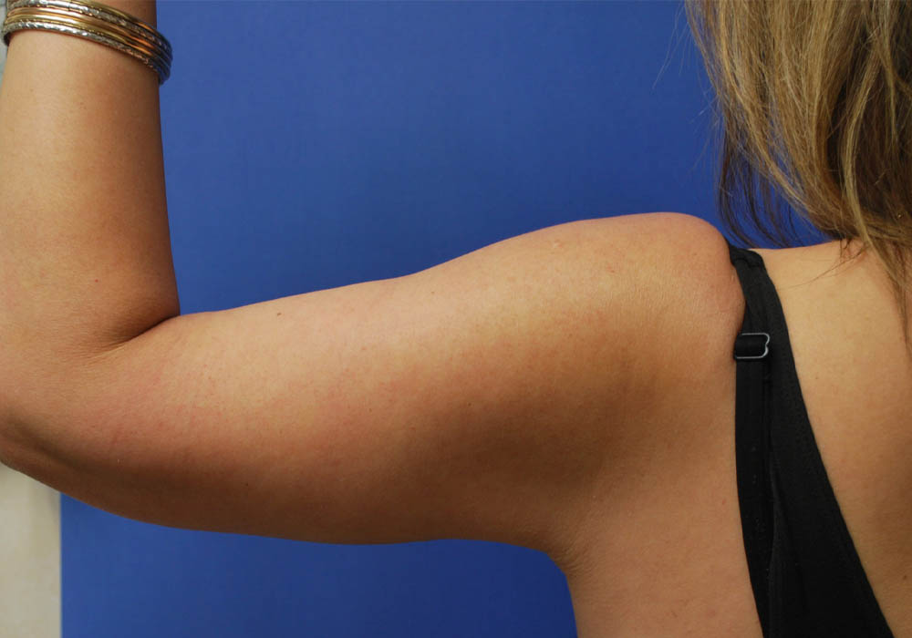 Arm Lift case #3728