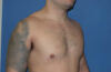 Male Breast Reduction case #4881