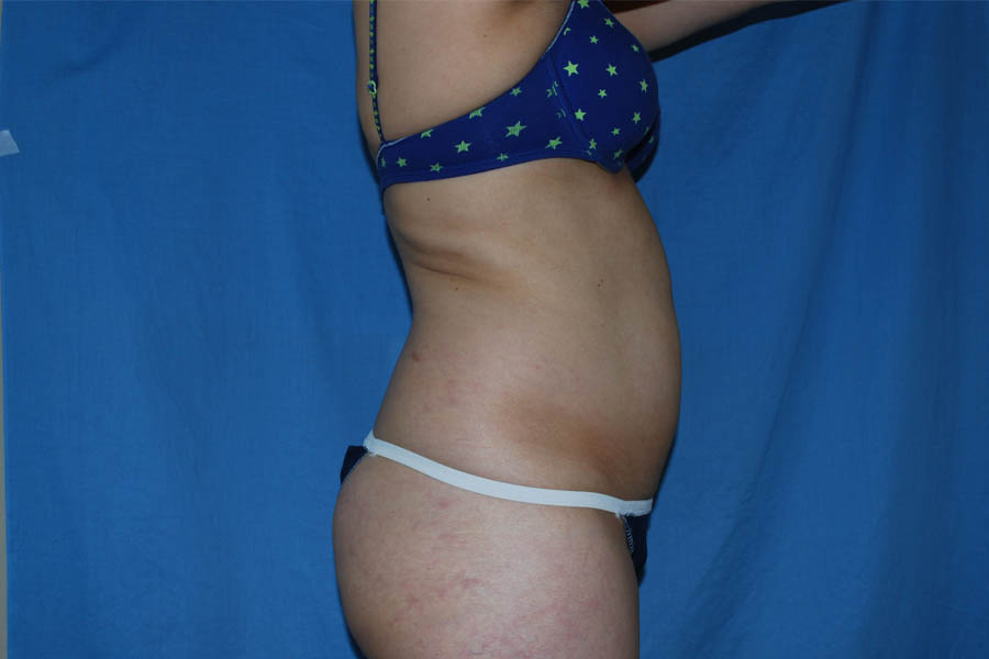 Liposuction case #4536