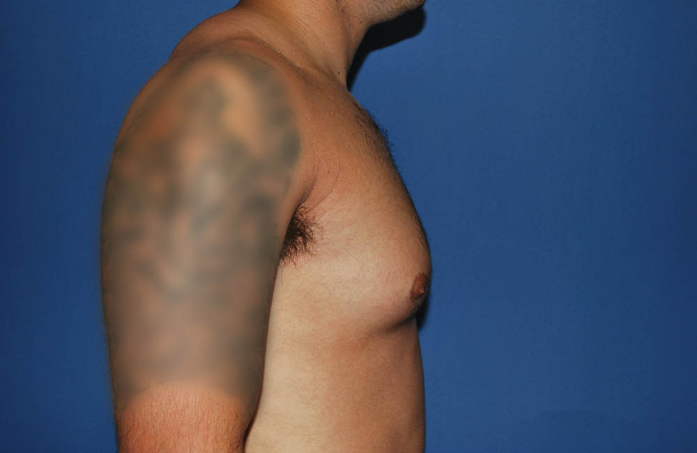 Male Breast Reduction case #4881