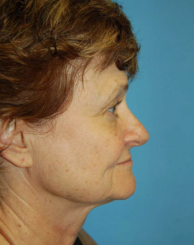 Forehead Lift case #4400