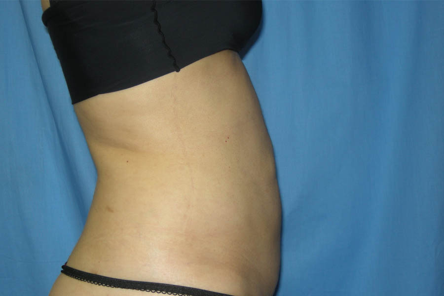 Liposuction case #4536