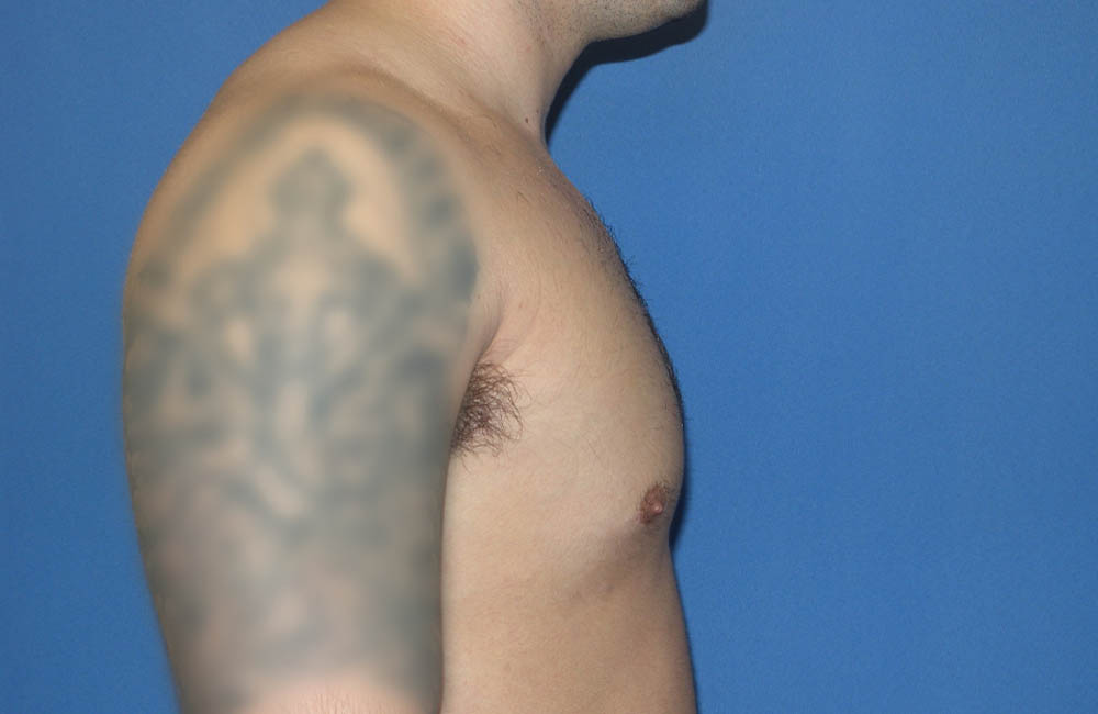 Male Breast Reduction case #4881