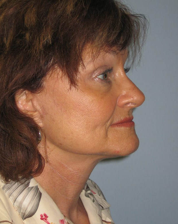 Forehead Lift case #4400