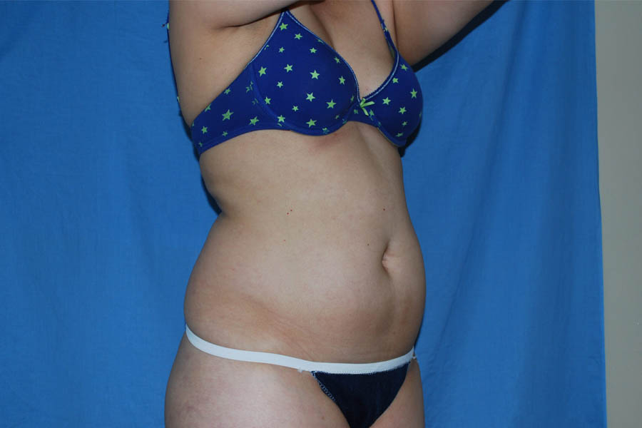 Liposuction case #4536