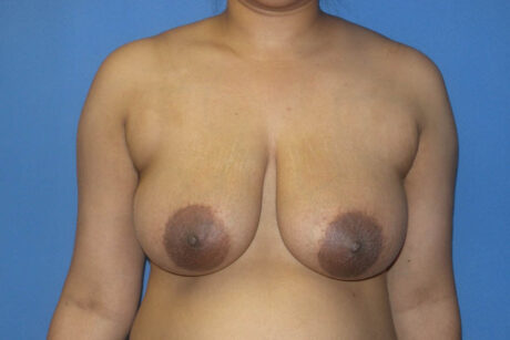 Breast Reduction case #4063