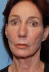 Neck Lift case #4986