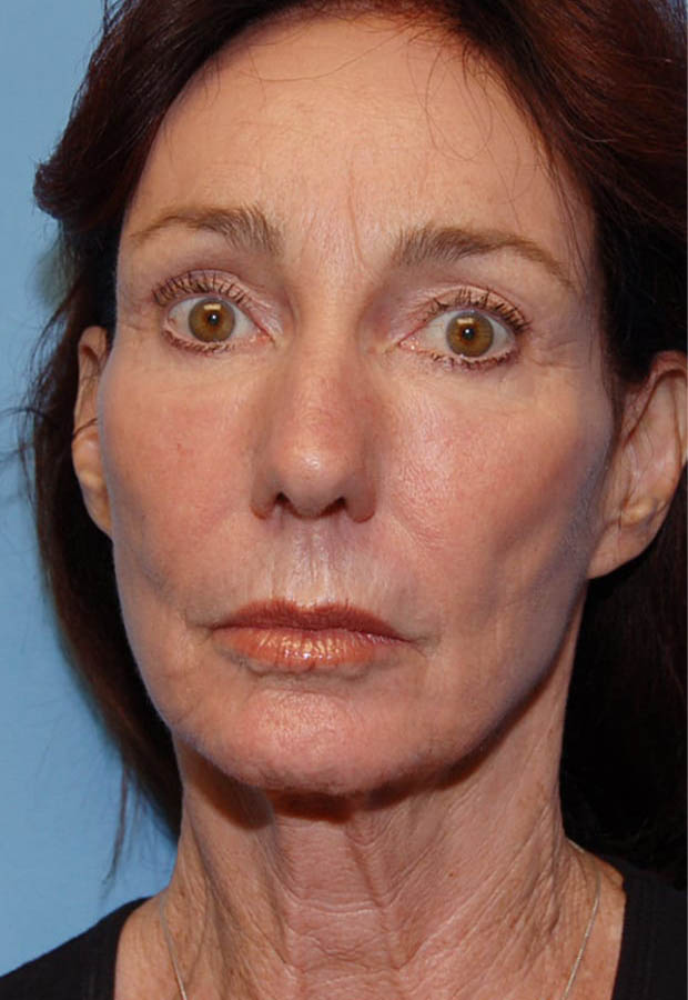 Neck Lift case #4986