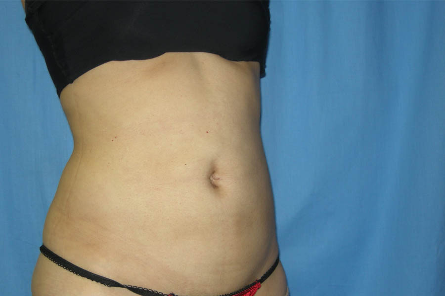 Liposuction case #4536