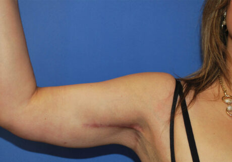 Arm Lift case #3728