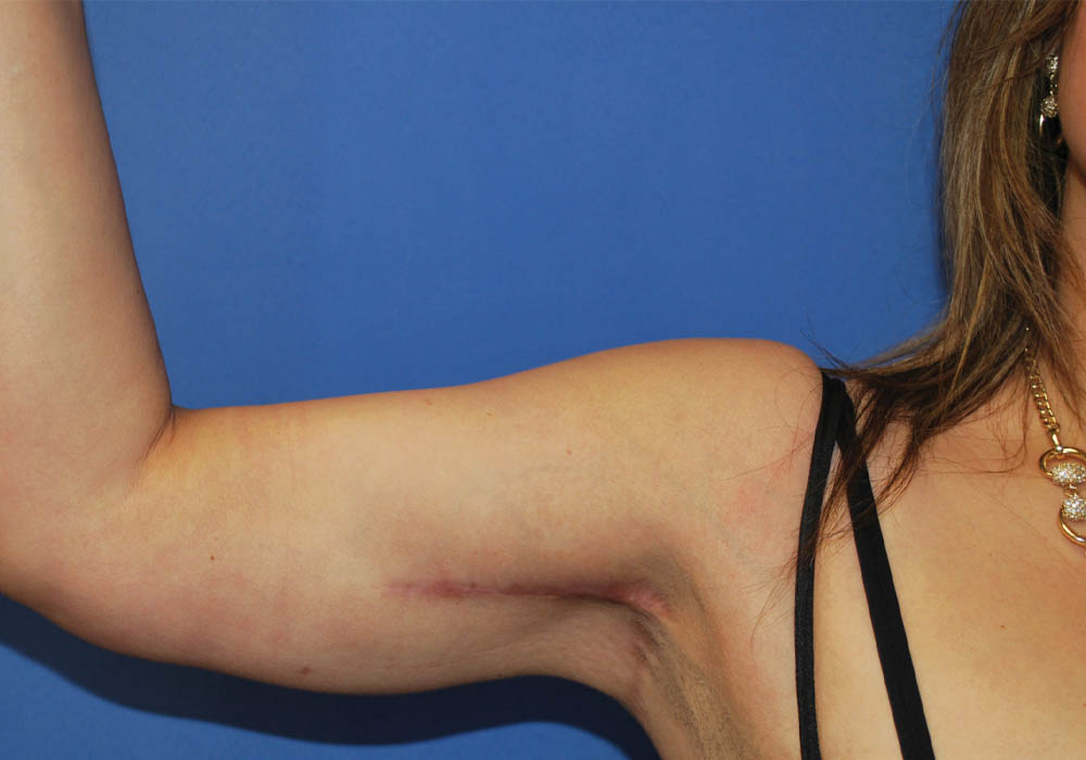 Arm Lift case #3728