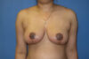 Breast Reduction case #4063