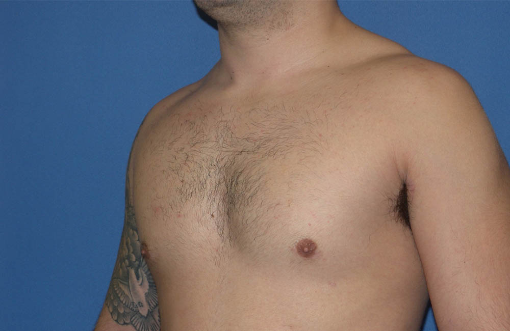 Male Breast Reduction case #4881
