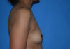 Breast Augmentation case #3944