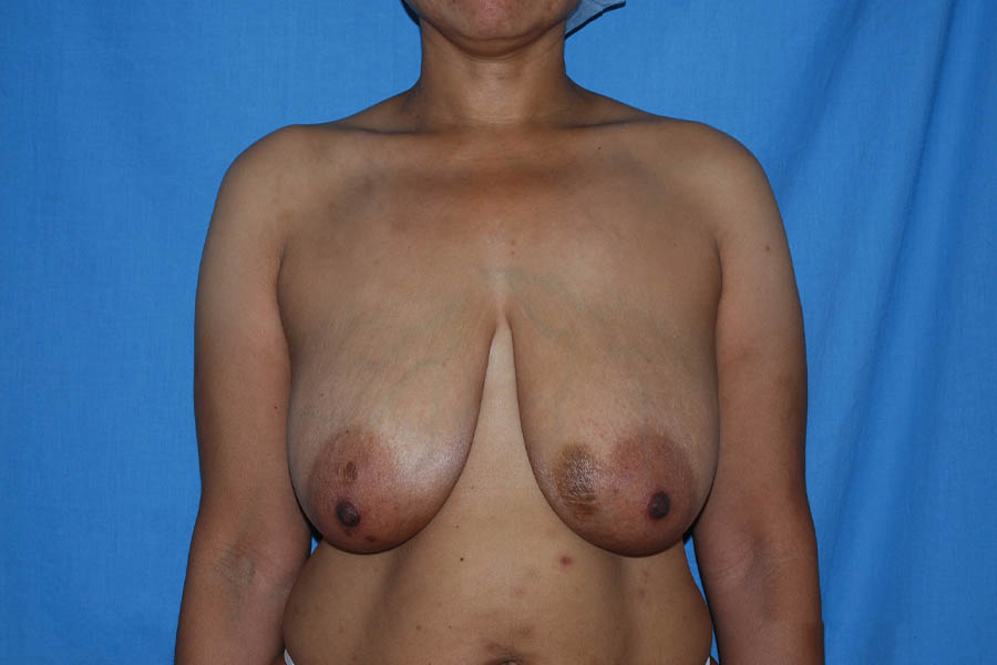 Breast Reduction case #4066