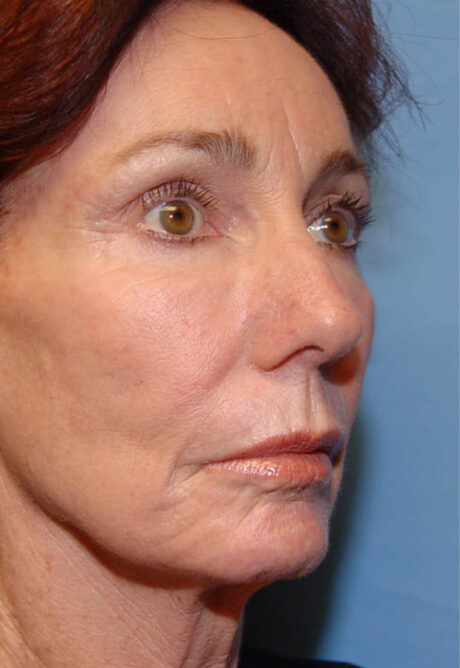 Neck Lift case #4986