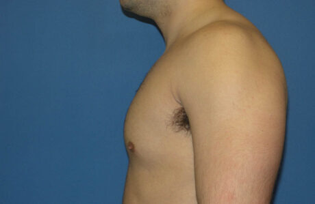 Male Breast Reduction case #4881