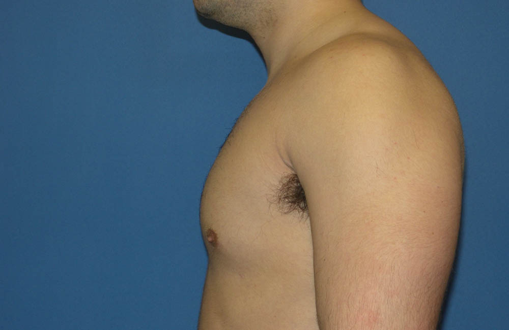 Male Breast Reduction case #4881
